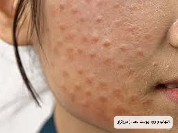 پوست صورت یک خانم که دچار ورم در نواحی تزریق کوکتل مزوتراپی شده است.