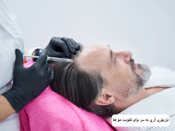 تزریق پی آر پی به موی سر یک آقا توسط پزشک.