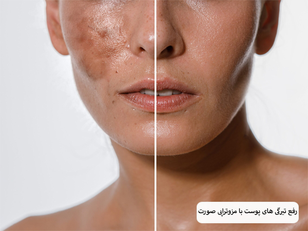 صورت بهبود یافته یک خانم بعد از مزوتراپی در پس زمینه سفید.