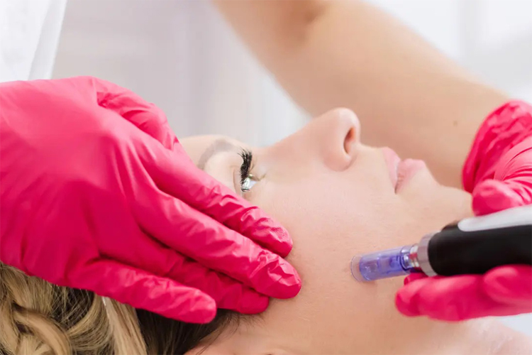 انجام پی آر پی روی پوست صورت یک خانم.