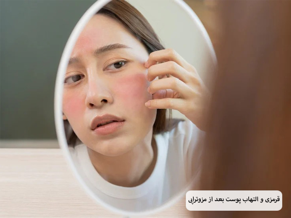 خانم جوان در حال بررسی التهاب پوست خود که در اثر مزوتراپی ایجاد شده است با آینه.