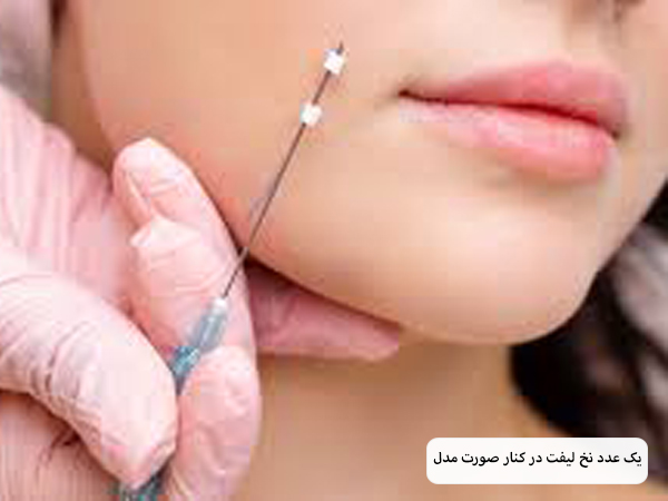 لیفت صورت یک خانم با نخ لیفت.