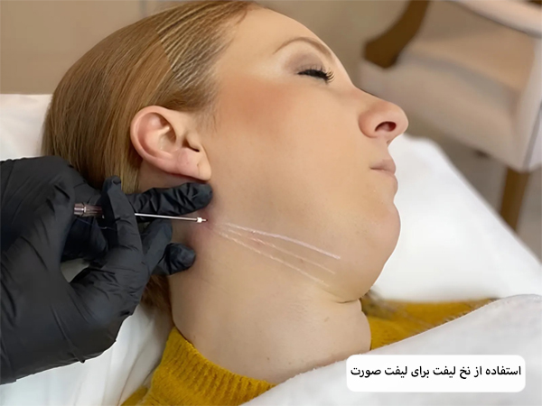 لیفت صورت یک خانم با نخ لیفت.