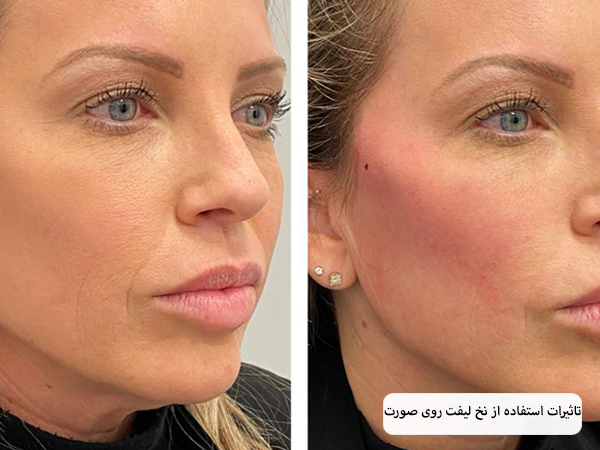 پزشک درحال انجام لیفت گونه زیبا جو با استفاده از نخ لیفت.