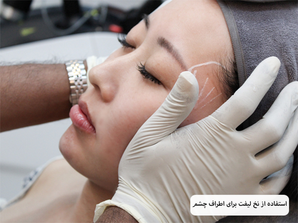 لیفت صورت یک خانم با نخ لیفت.