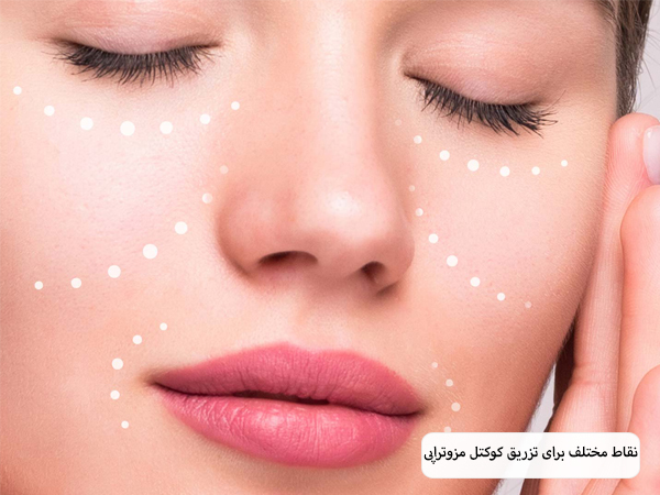 نقاط مناسب انجام مزوتراپی روی صورت یک خانم نمایش داده شده است.