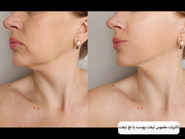 صورت یک خانم قبل و بعد از لیفت با نخ.