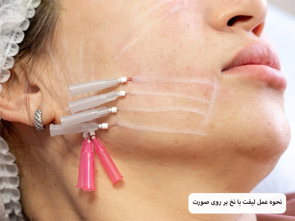 صورت یک خانم قبل و بعد از لیفت با نخ.