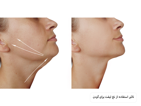 پوست گردن یک خانم قبل و بعد از لیفت با نخ در پس زمینه سفید.