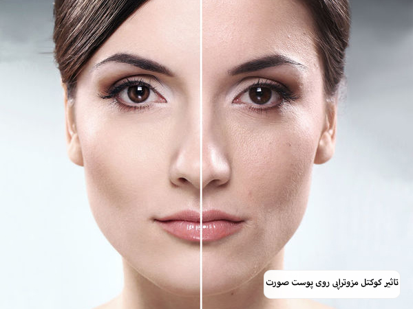 تزریق کوکتل مزوتراپی به صورت یک زیباجو.