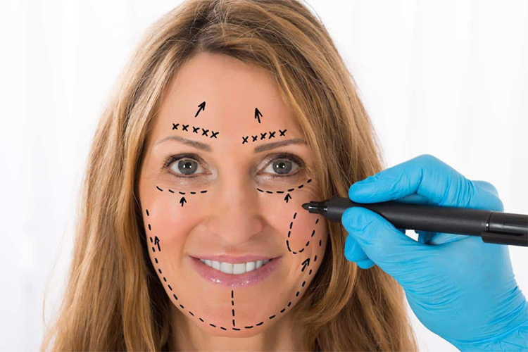 علامت گذرای صورت با ماژیک قبل از عمل لیفت با پس زمینه سفید.