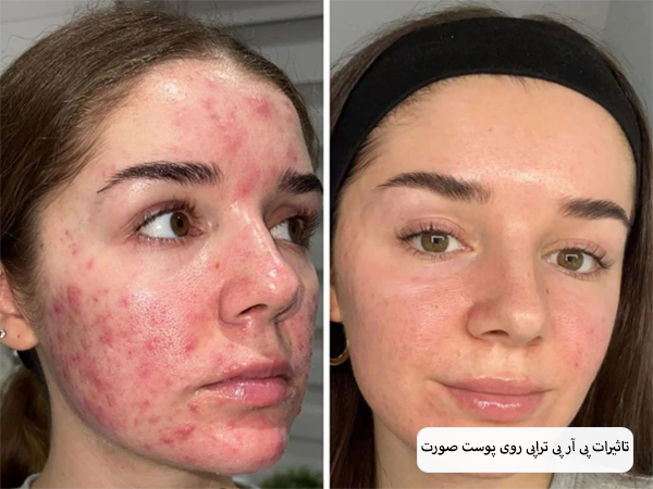 صورت یک خانم قبل و بعد از انجام پی آر پی تراپی.