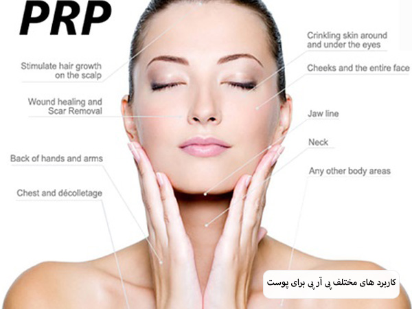 کاربرد های مختلف پی آر پی تراپی که در کنار صورت یک خانم نمایش داده شده است با پس زمینه سفید.