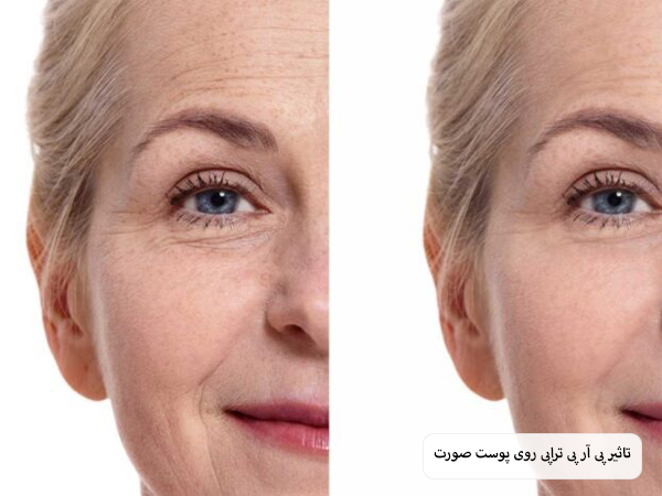 تزریق پی آر پی به موهای یک مرد جوان.