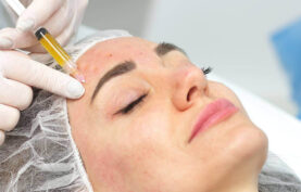 انجام پی آر پی روی پوست صورت یک خانم.