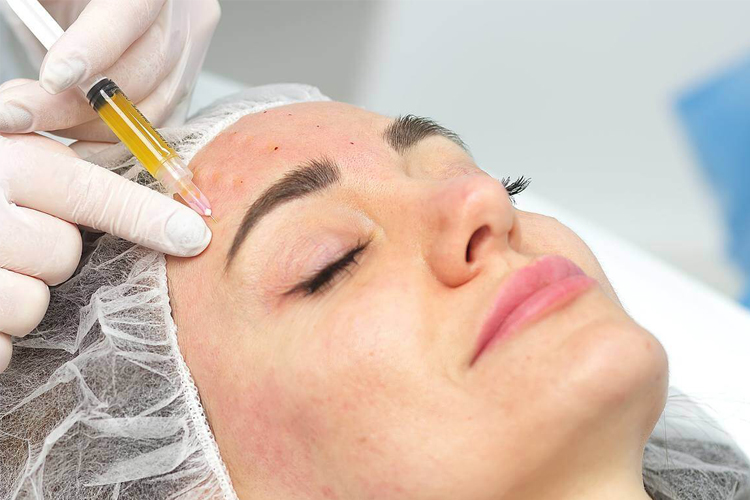 انجام پی آر پی روی پوست صورت یک خانم.