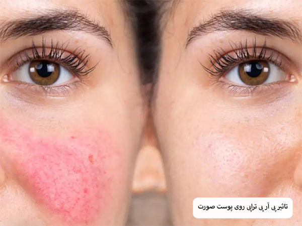 چند نمونه نخ لیفت مختلف که به صورت ردیفی در کنار هم قرار گرفته اند با پس زمینه سفید.