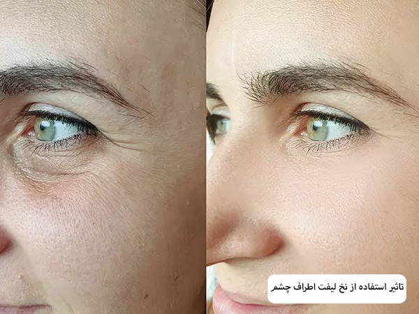 پوست گردن یک خانم قبل و بعد از لیفت با نخ در پس زمینه سفید.